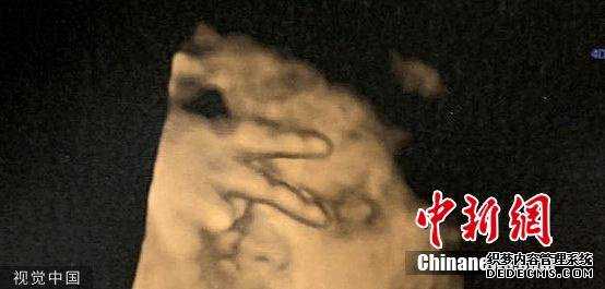 上海女人供卵试管最好年龄,上海打夜针卵泡只有14,【圆梦行动精准代孕】